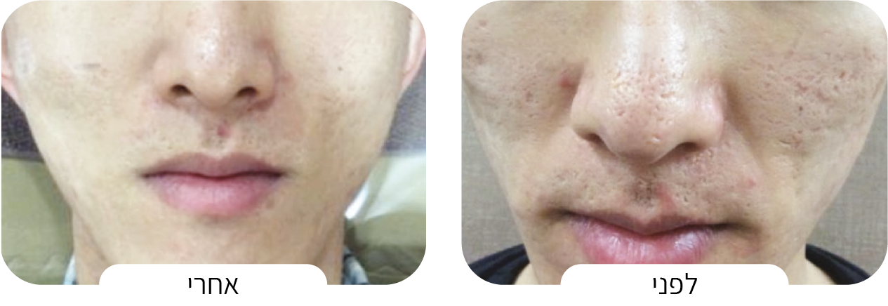 טיפול בצלקות אקנה