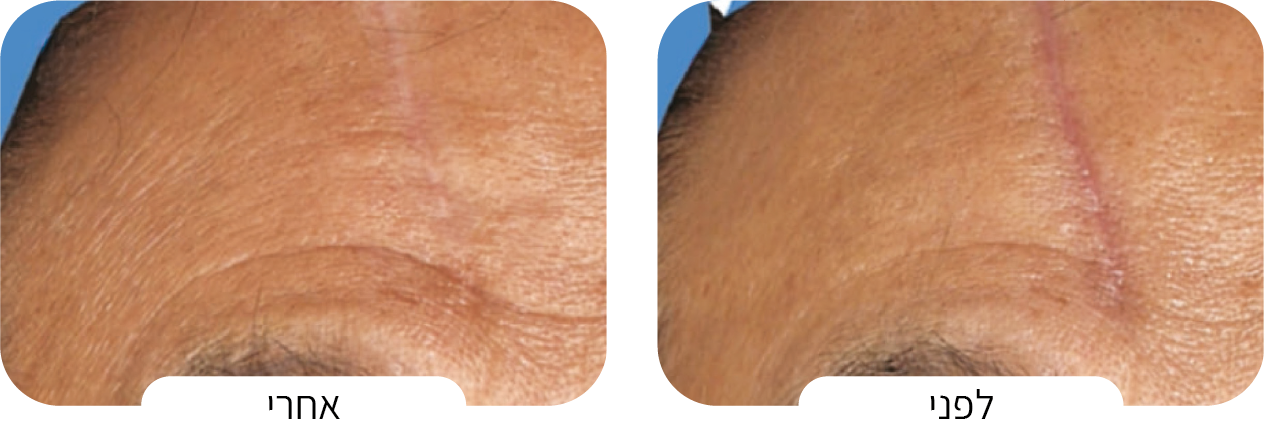 טיפול בצלקות