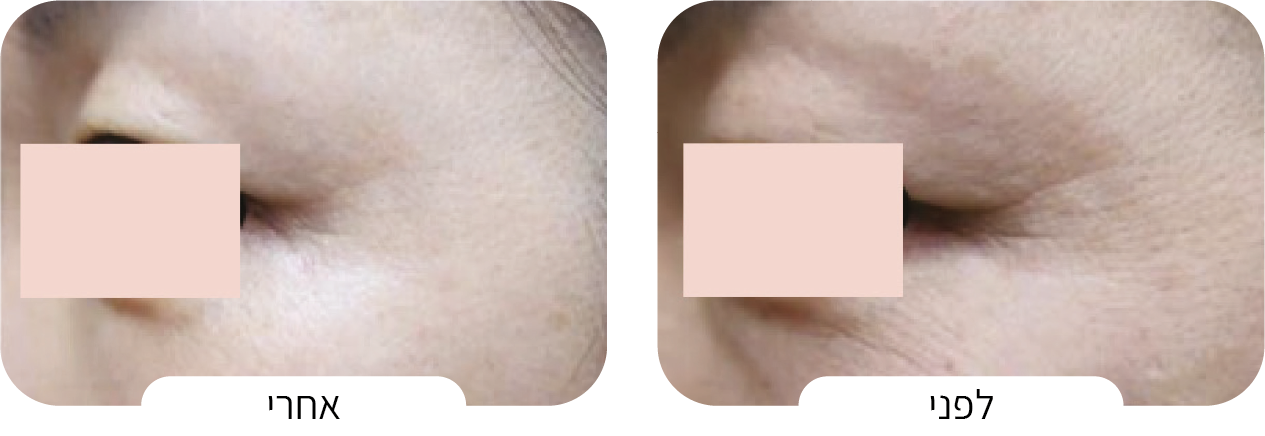 טיפול בקמטוטים וקמטים עדינים